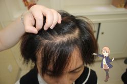 -大麦微针植发丨全国连锁