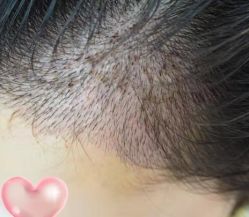 -大麦微针植发丨全国连锁