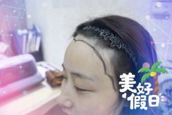 -大麦微针植发全国连锁