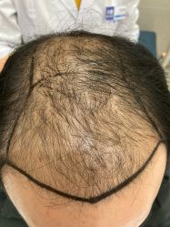 点击看大图 -大麦微针植发全国连锁