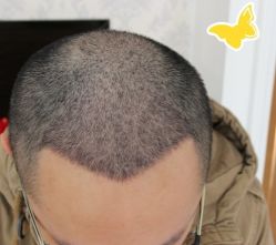 -大麦微针植发丨全国连锁