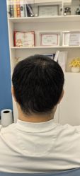 -大麦微针植发全国连锁