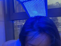 -碧莲盛·不剃发植发