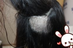 点击看大图 -大麦微针植发丨全国连锁