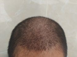 -碧莲盛·不剃发植发