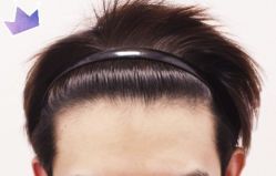 -大麦微针植发丨全国连锁