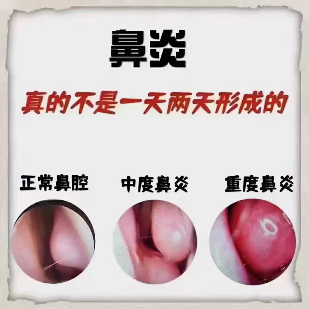 有的慢呢
❤刚肿的鼻甲是软的,时间拖太久就发硬,发硬了就不好,要