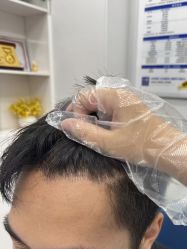 -大麦微针植发全国连锁