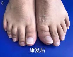 -德哥灰指甲脚气甲沟炎跖疣护理