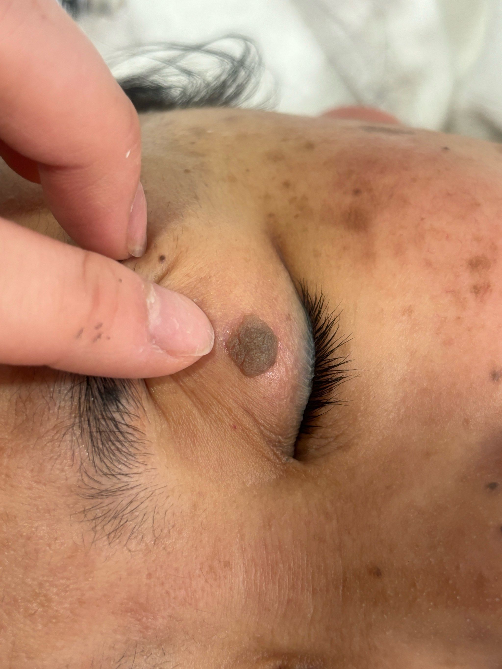 祛除眼皮上的疣前🆚祛除后对比效果图