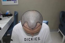 -大麦微针植发全国连锁