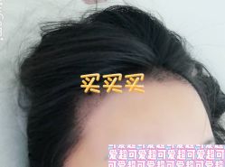 -大麦微针植发全国连锁