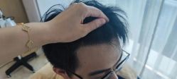 -大麦微针植发丨全国连锁