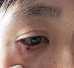 -北京美痣堂古方祛痣斑疣瘊