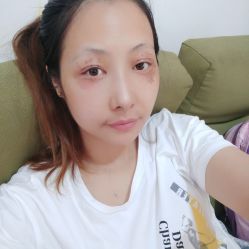 -爱莎扁平疣·汗管瘤·斑痣中心