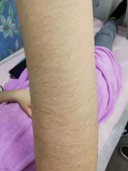 -薇兰专业脱毛连锁机构