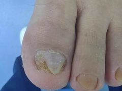 -Andrew指甲专科灰指甲·甲沟炎矫正·3D步态矫形鞋垫定制(浦三路店)