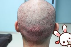 点击看大图 -大麦微针植发丨全国连锁