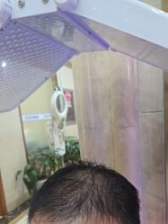 -碧莲盛·不剃发植发