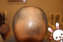 点击看大图 -大麦微针植发丨全国连锁