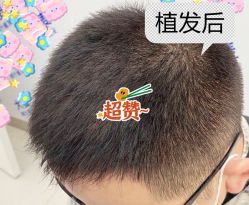 -大麦微针植发全国连锁