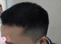 -大麦微针植发丨全国连锁