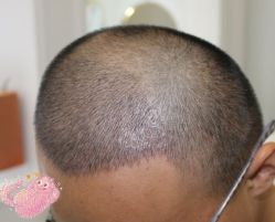 -大麦微针植发丨全国连锁