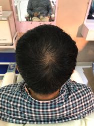 -大麦微针植发全国连锁