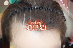 -大麦微针植发全国连锁