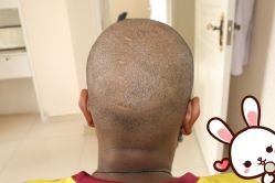 点击看大图 -大麦微针植发丨全国连锁