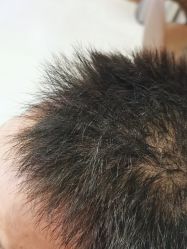 点击看大图 -新生植发·植养护一体