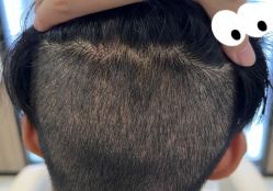 -大麦微针植发全国连锁