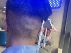 -碧莲盛·不剃发植发