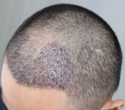 -大麦微针植发丨全国连锁