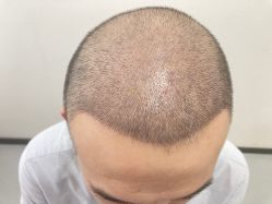 点击看大图 -大麦微针植发全国连锁