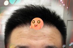 -大麦微针植发全国连锁