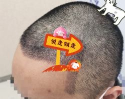 -大麦微针植发全国连锁