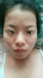 -苗方清颜专业祛痘
