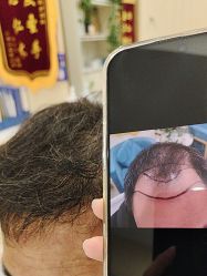 -碧莲盛·不剃发植发