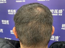 -碧莲盛·不剃发植发