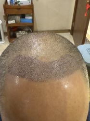 -碧莲盛·不剃发植发