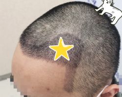 -大麦微针植发全国连锁