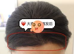 -大麦微针植发全国连锁