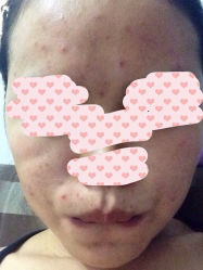iphone_upload_pic-苗方清颜专业祛痘