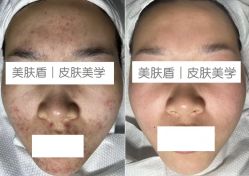 -美肤盾祛痘·问题肌头疗管理中心