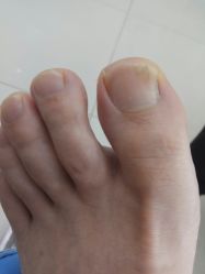 -派恩宜灰指甲鸡眼嵌甲手足癣