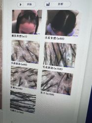 -大麦微针植发全国连锁