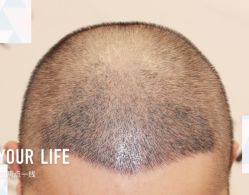 -大麦微针植发全国连锁