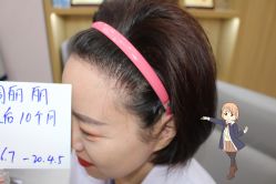 -大麦微针植发丨全国连锁