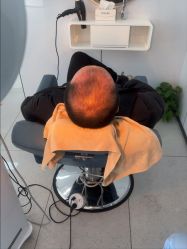 -大麦微针植发丨全国连锁